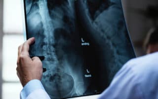Stem cell treatment for low back pain