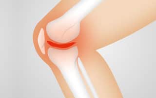 Illustration of the knee joint representing grafts in ACL surgery