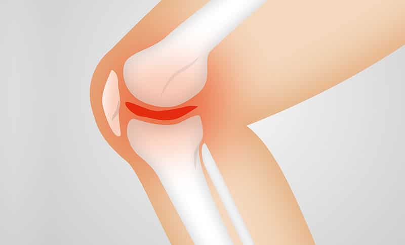 What You Need to Know About Grafts in ACL Surgery