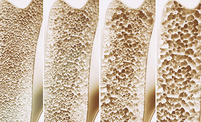 Osteoporosis: What You Should Know at All Ages