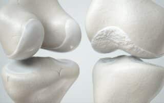 debunking arthritis myths - illustration of healthy knee and arthritic knee