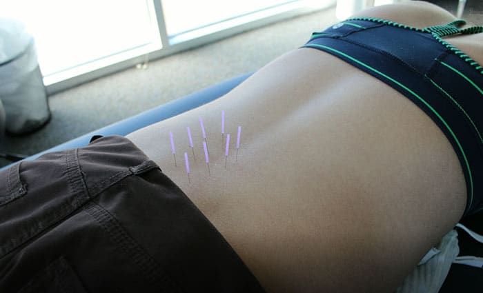 Dry Needling at Cary Ortho