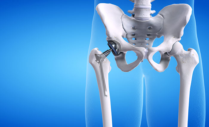 What is a Total Hip Replacement? - Cary Orthopaedics