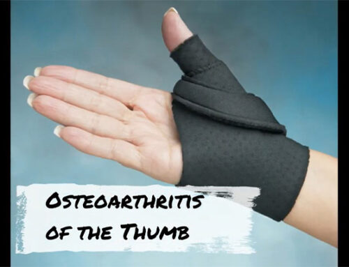 Patient Education Series: Treating Osteoarthritis of the Thumb