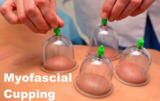 myofascial cupping physical therapy technique