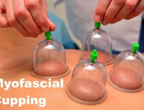 Patient Education Series: Myofascial Cupping