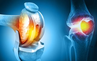 illustration of artificial joint representing what is a total knee replacement