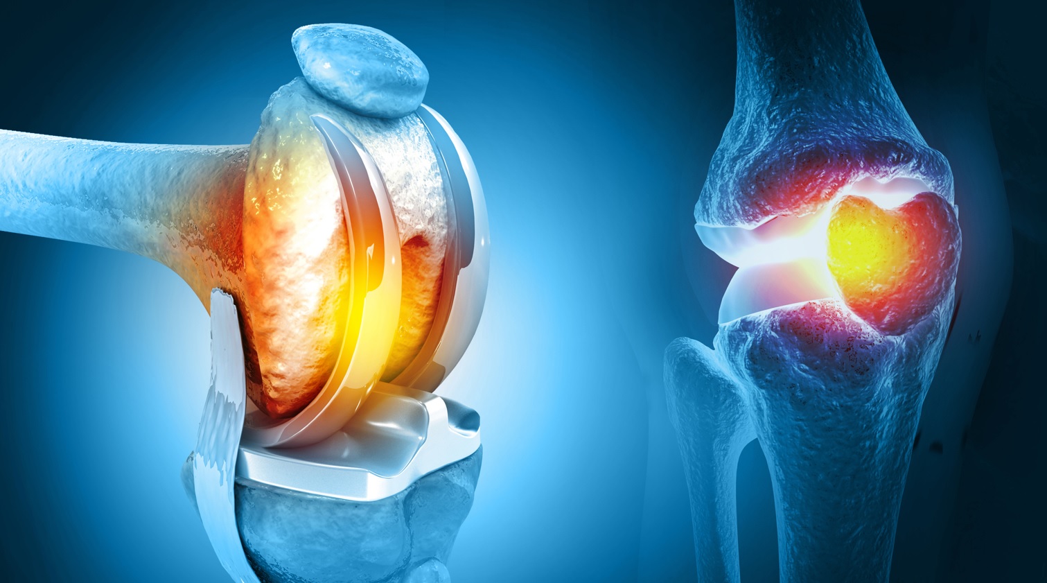 illustration of artificial joint representing what is a total knee replacement