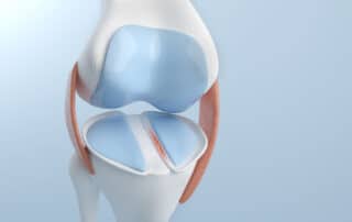 A 3D illustration depicting knee pain caused by a meniscus injury and a complete ACL tear.
