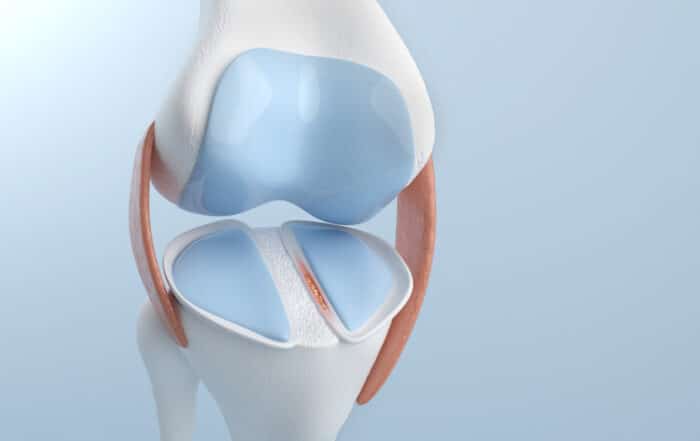 A 3D illustration depicting knee pain caused by a meniscus injury and a complete ACL tear.